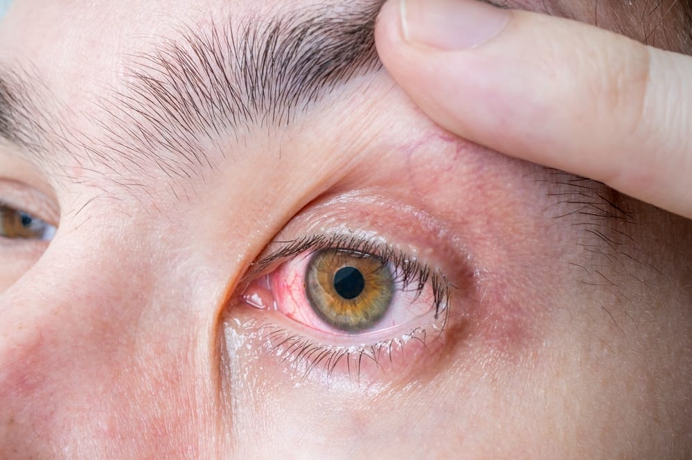 Oczy - objawy boreliozy - BRM-MED